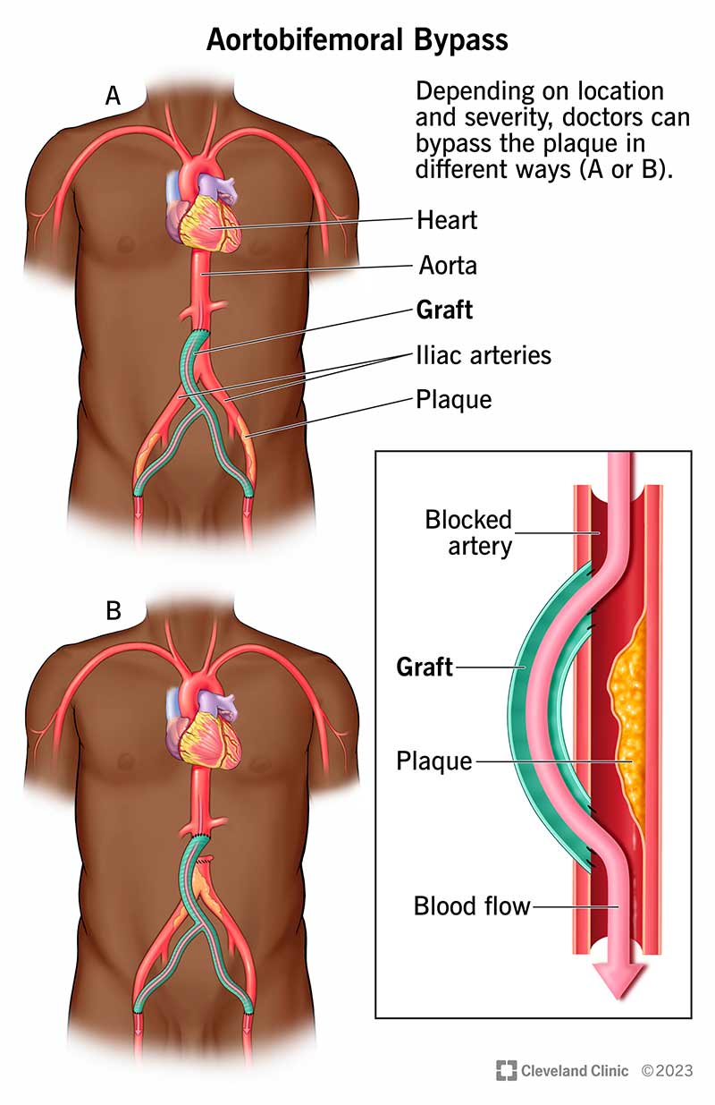 Illustration showing the location of an aortobifemoral bypass graft.