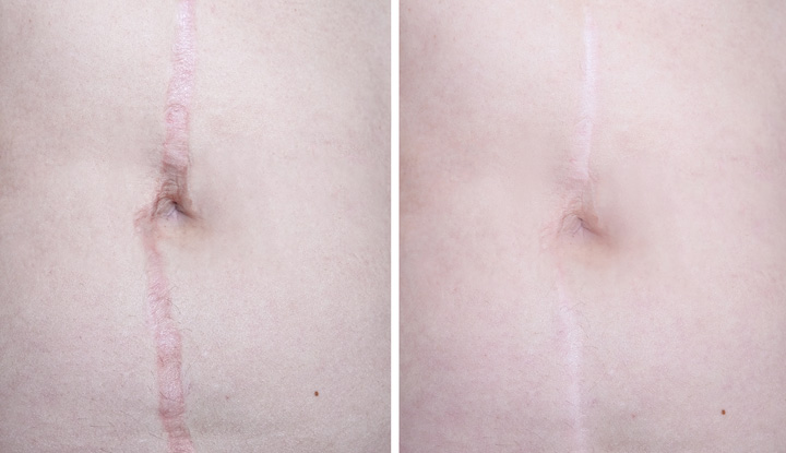 An abdominal scar before and after scar revision, which helps the scar blend with the surrounding skin.