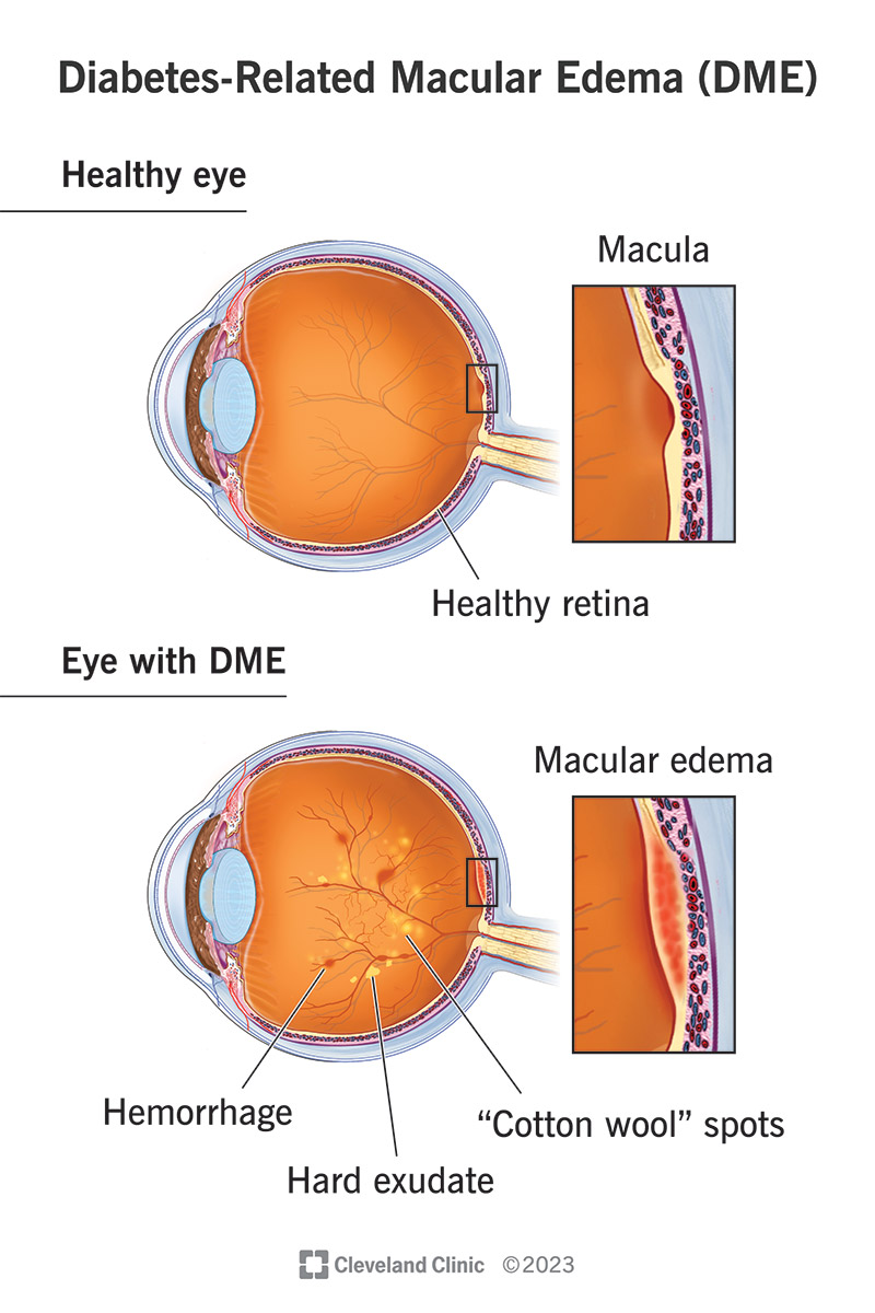 A person with diabetes-related macular edema may have swelling, hemorrhages, hard exudates and ‘cotton wool’ spots in your eye, unlike a person who has a healthy macula and retina.