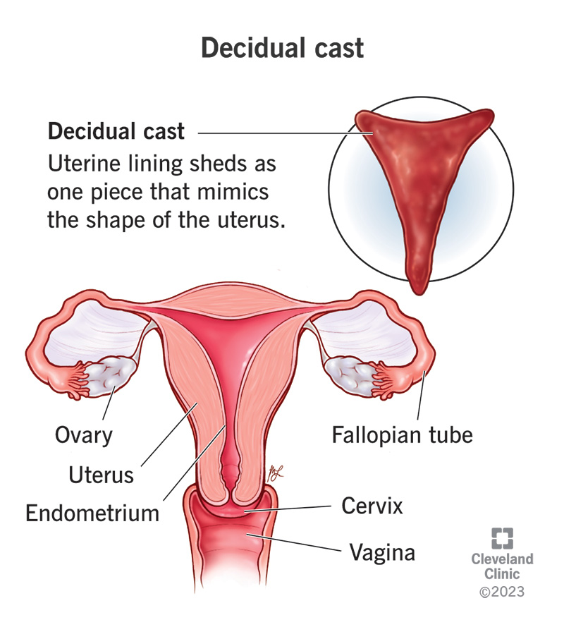 This is called a decidual cast. It occurs when the lining of a woman's  uterus sheds as one massive solid piece of tissue during her period. :  r/MakeMeSuffer