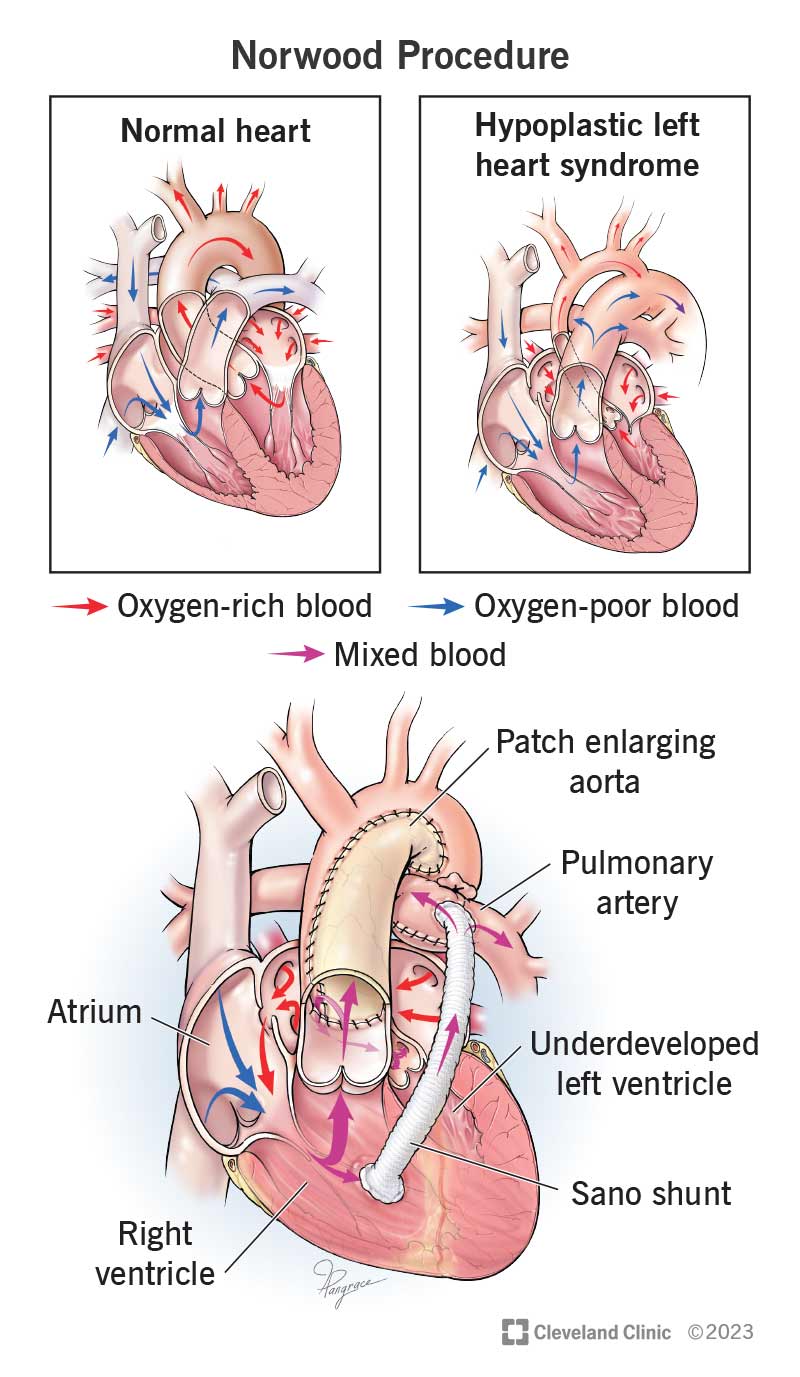 A Norwood procedure improves blood circulation in babies with hypoplastic left heart syndrome (HLHS).