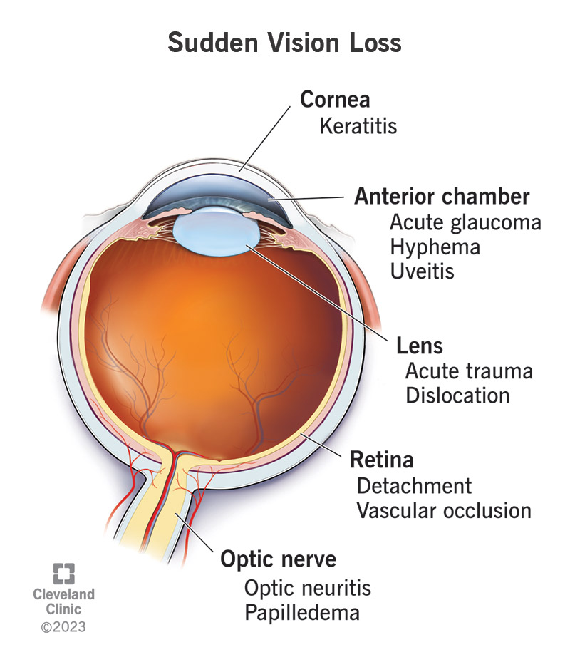 Sudden vision loss can result from various conditions that may affect parts of your eye, including your cornea, anterior chamber, lens, retina or optic nerve.