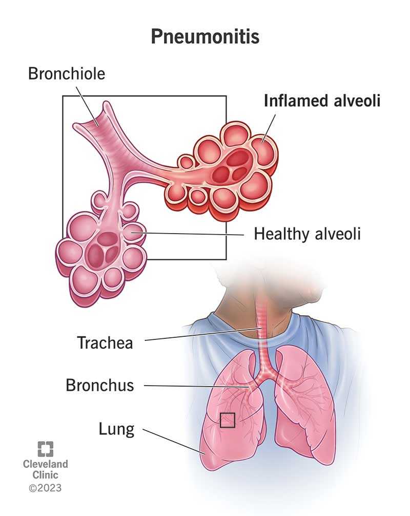 Pneumonitis is when an irritant enters your lungs and causes inflammation in your alveoli.