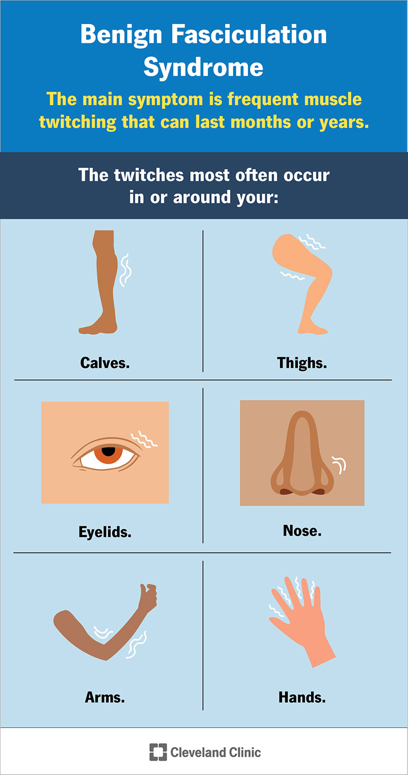 Benign Fasciculation Syndrome Symptoms Treatment