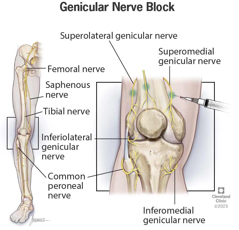 Illustration showing various nerves around your knee. It shows an injection targeting the superomedial genicular nerve.