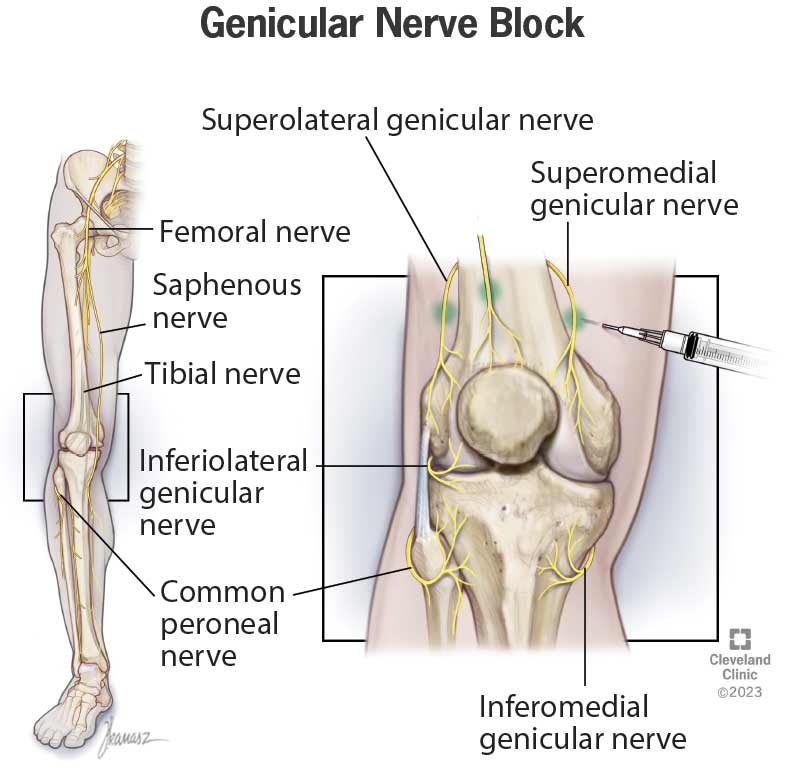 femoral nerve block distribution