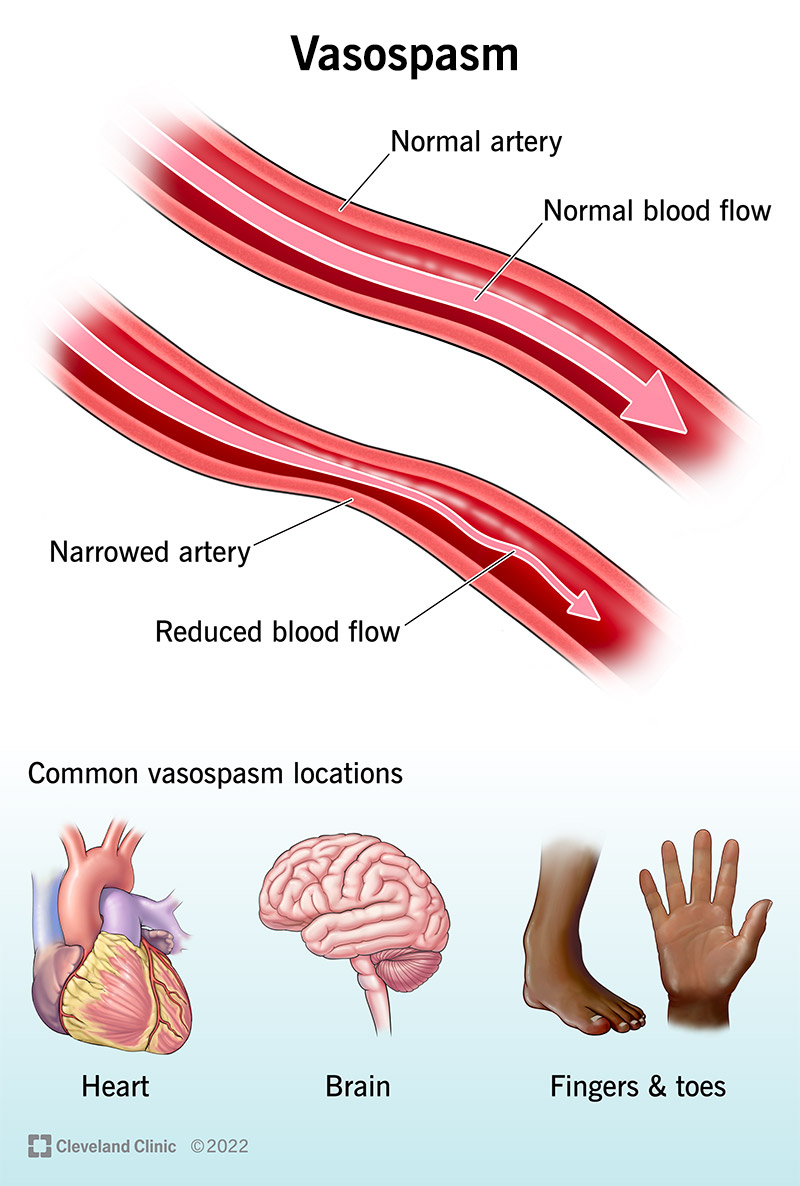 A vasospasm creating reduced blood flow in an artery.