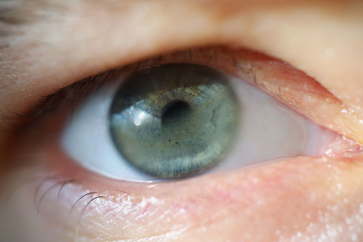 Calcium deposits in corneal layers can make parts of the normally transparent cornea look murky.