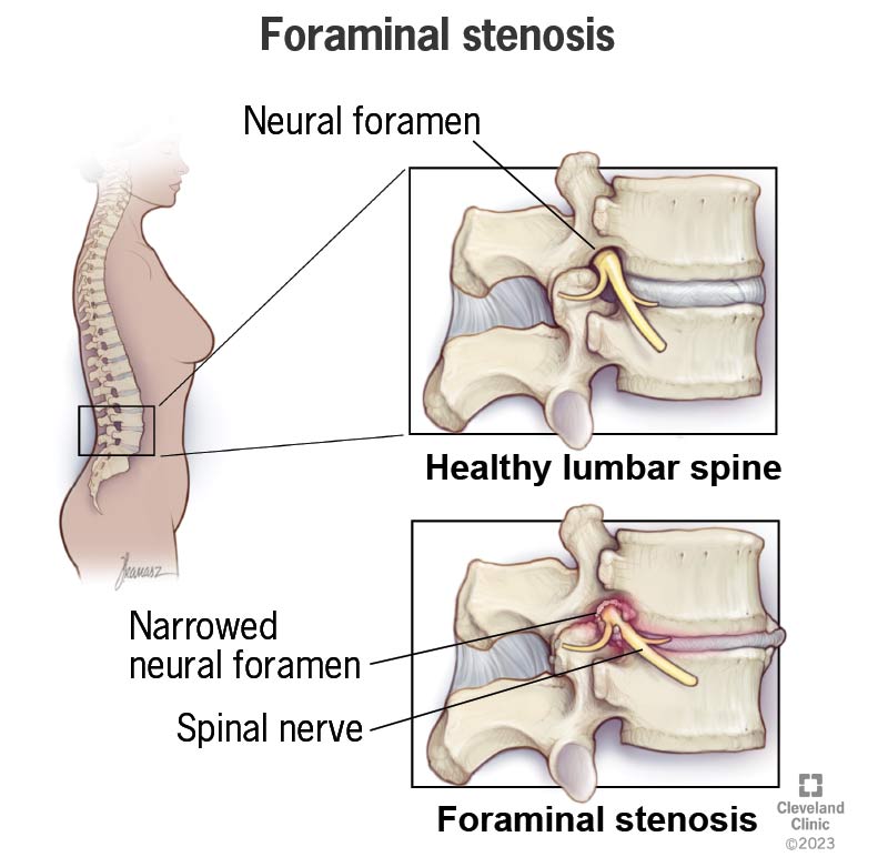 Foraminal Stenosis: What It Is, Symptoms, Types & Treatments