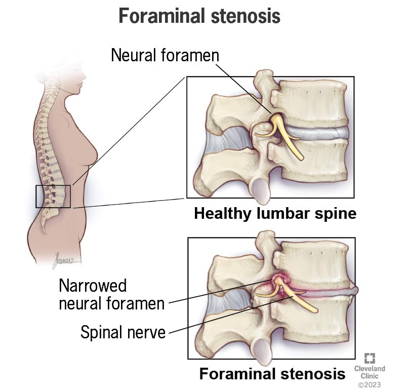 Spinal stenosis - causes, symptoms and treatment