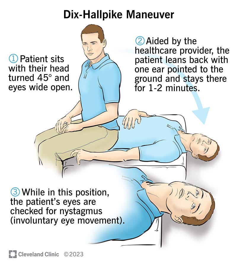 Dix-Hallpike Maneuver: Test, Purpose & Results