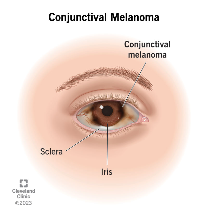 Conjunctival melanoma can look like a freckle or brown spot in the conjunctiva that may cover part of the iris and sclera .