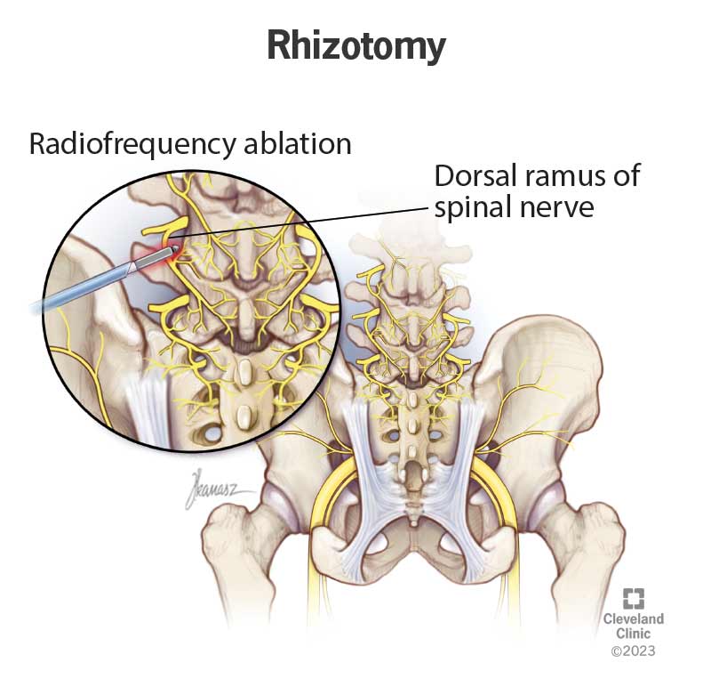Illustration of radiofrequency ablation tool damaging the dorsal ramus of a spinal nerve near the pelvis.