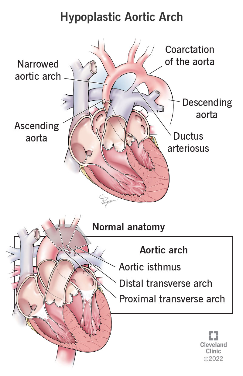 Coarctation of the aorta with aortic arch hypoplasia, and a normal aortic arch anatomy.