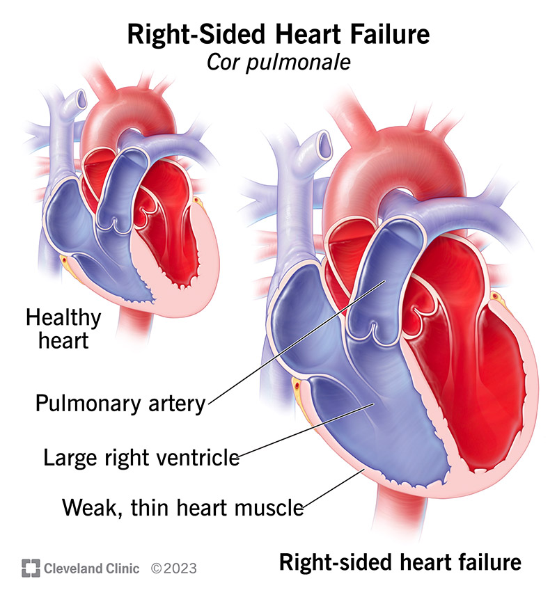 A heart with cor pulmonale compared to a normal heart