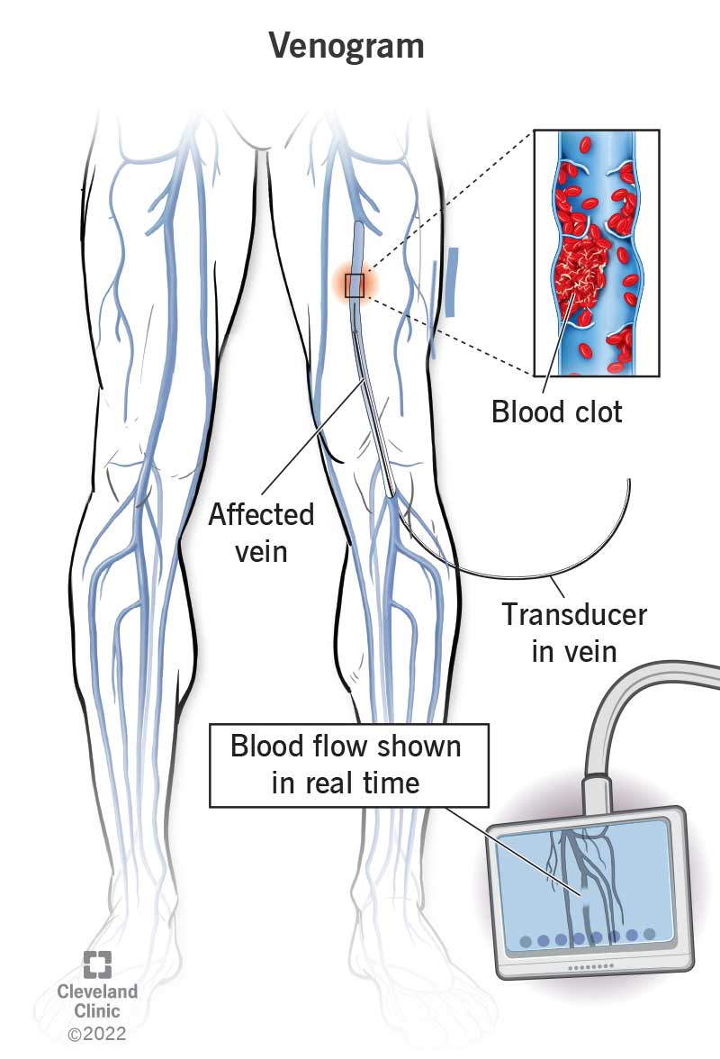 Illustration showing veins in a person’s legs along with a callout highlighting the presence of a blood clot in the thigh.