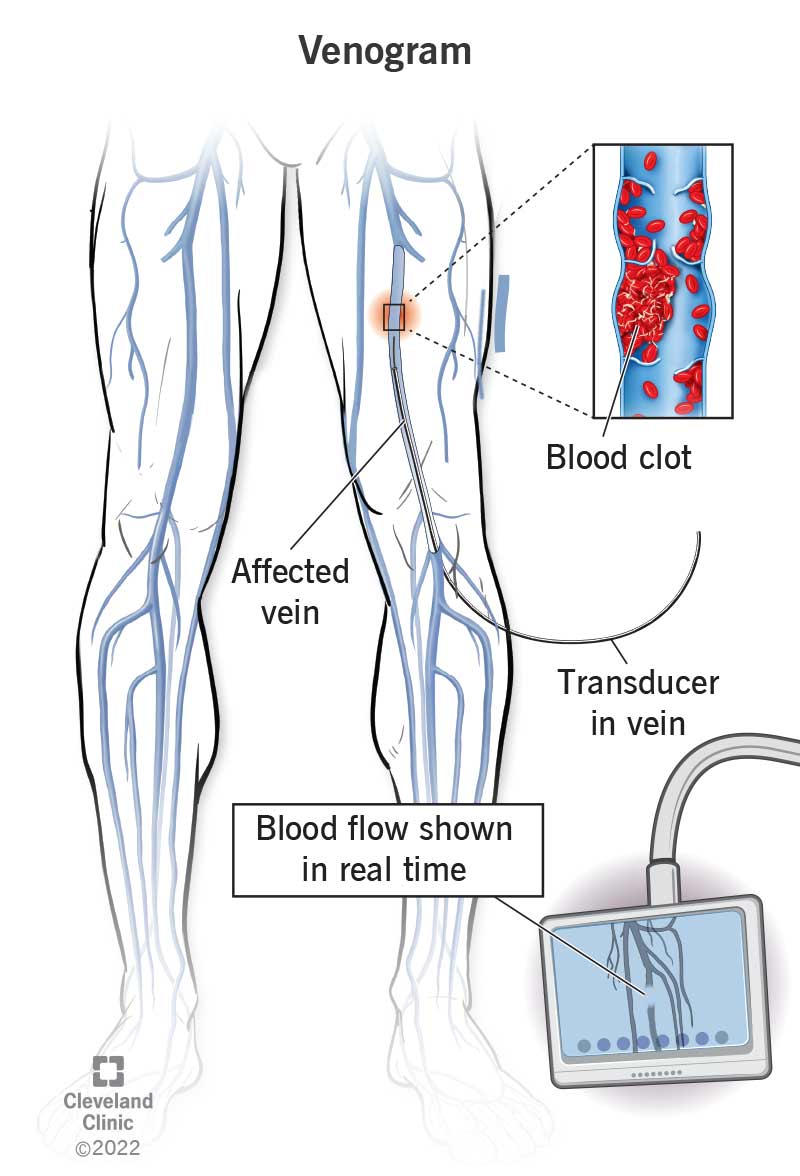 Venogram: Procedure Details & Recovery