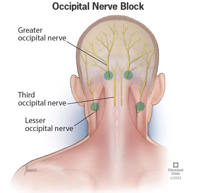 Illustration of the occipital nerves in the back of the head and neck. It shows the injection at the back side of the neck.