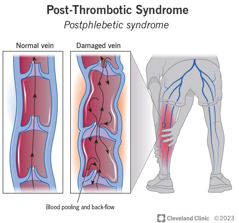 Blood should normally flow back up to your heart but can collect in one place or flow the wrong way in a damaged vein.