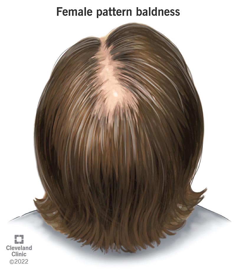 Female pattern baldness causes a wide gap in a woman's center hair part.