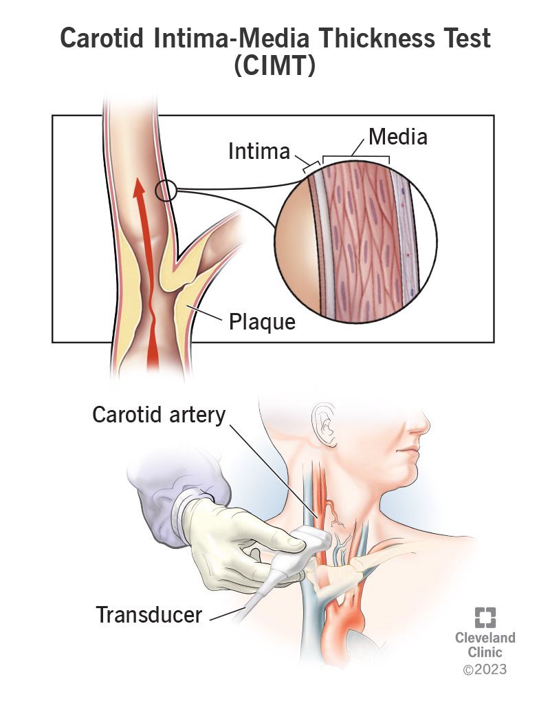 Testing for the thickness of the intima and media in your carotid artery wall helps determine plaque buildup.