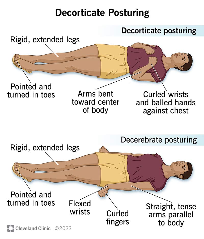 Decorticate posturing (and the related decerebrate posturing) are reflex body positions someone in a coma may show.