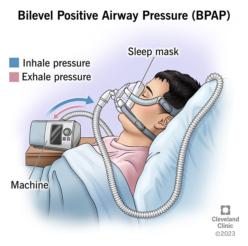 Artwork of person wearing a mask connected to a BiPAP machine with hoses. Arrows show inhalation and exhalation pressure.