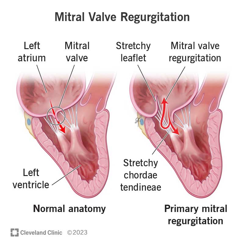 Normal valve and mitral regurgitation. Damaged parts prevent the valve from fully closing, causing blood to leak backward.
