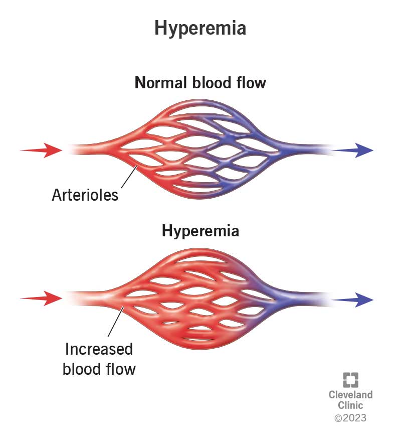 Normal blood flow compared to the increased blood flow of hyperemia.