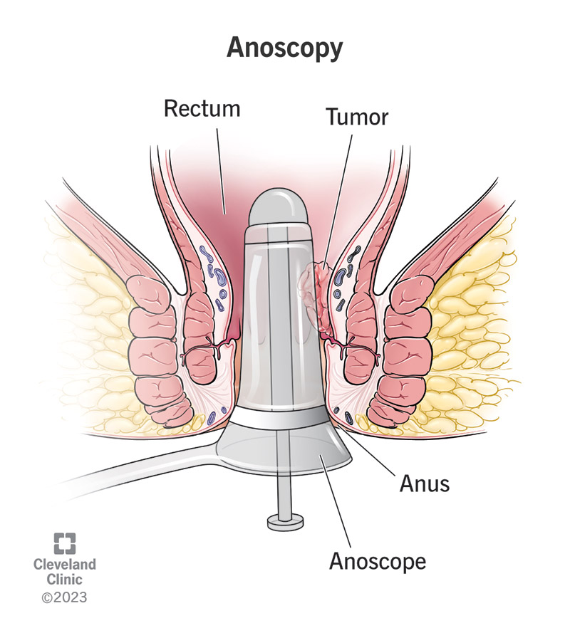 An anoscopy uses an anoscope to examine inside your anus.