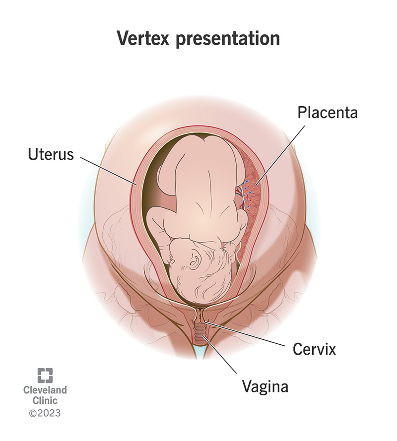 what is the meaning of vertex presentation in pregnancy