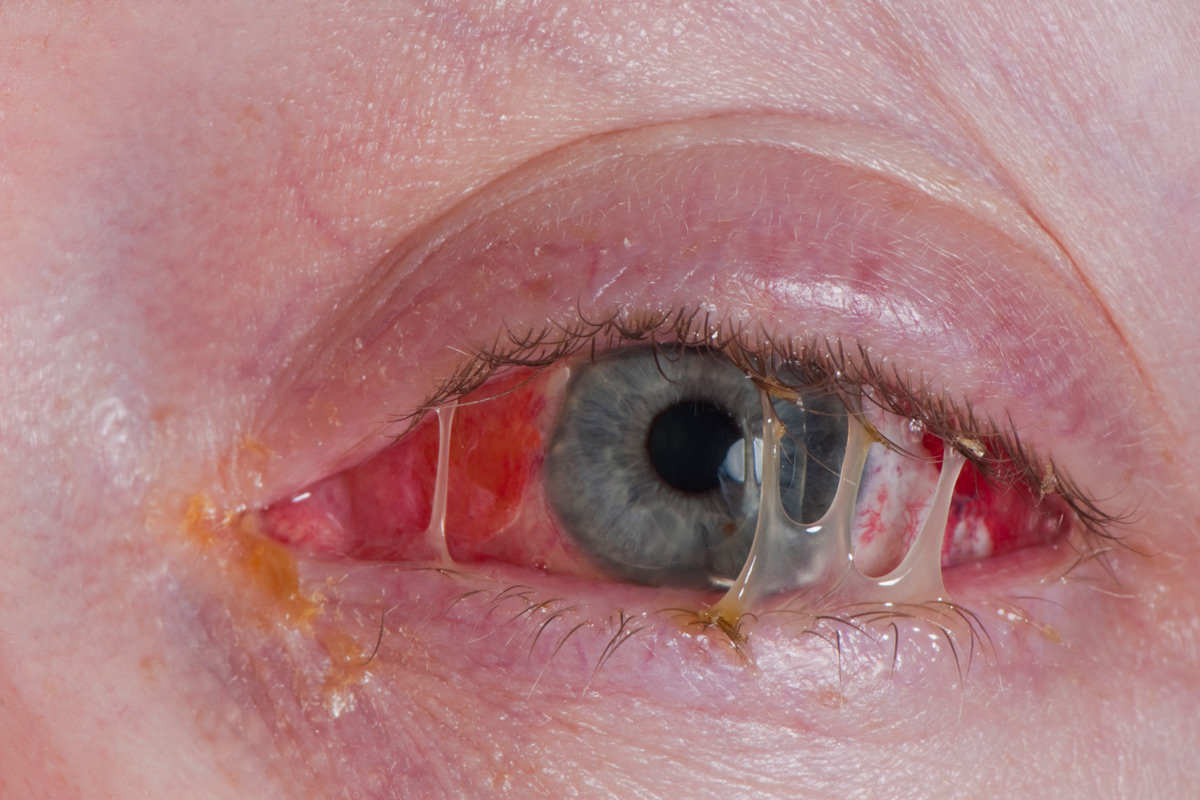 What is pink eye caused by?