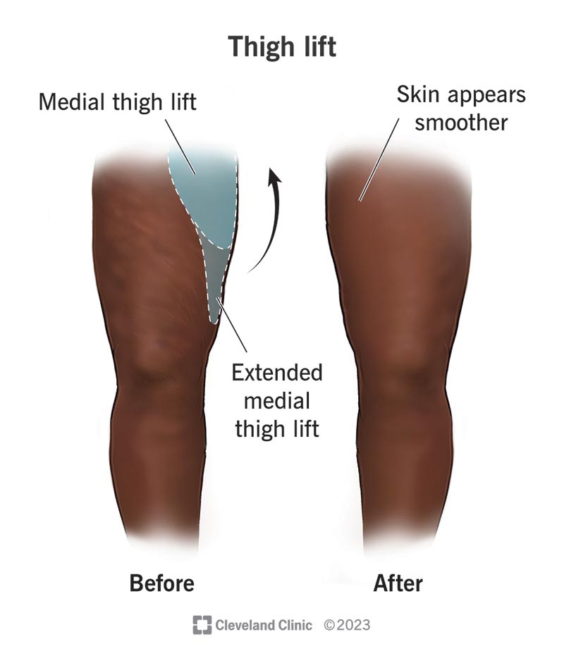 A person’s thighs before and after a thigh lift (thighplasty) procedure.