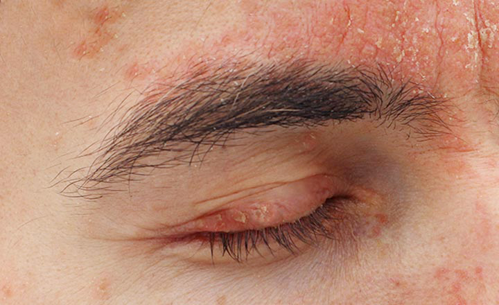A person with scaly patches of psoriasis on their eyelid and on their eyebrow.