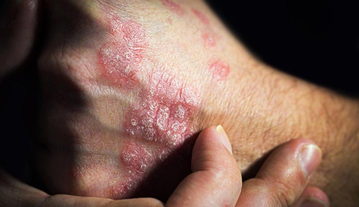 The back of a person’s hand has scaly patches of psoriasis.