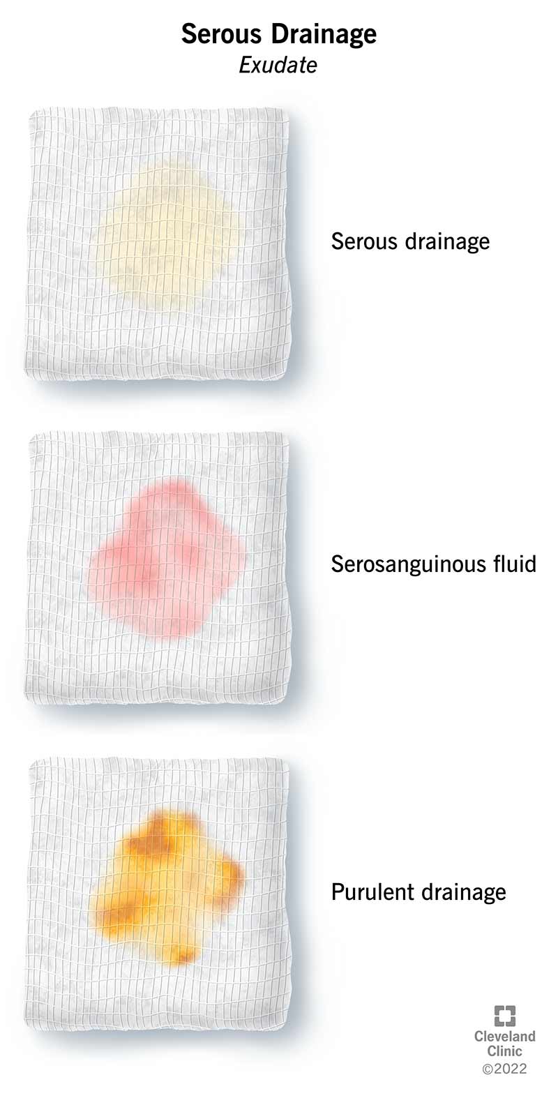 An illustration of three wound dressings with serous drainage and other types of exudate.