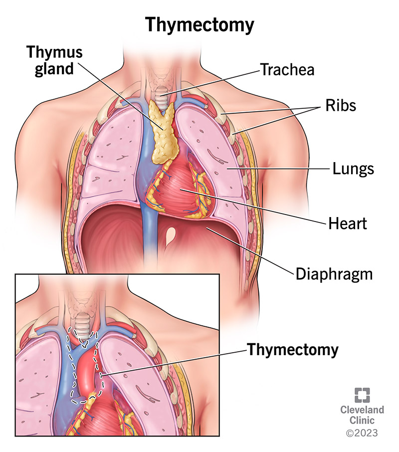 The thymus gland rests just below the trachea and between the lungs. In a thymectomy, this gland is removed.