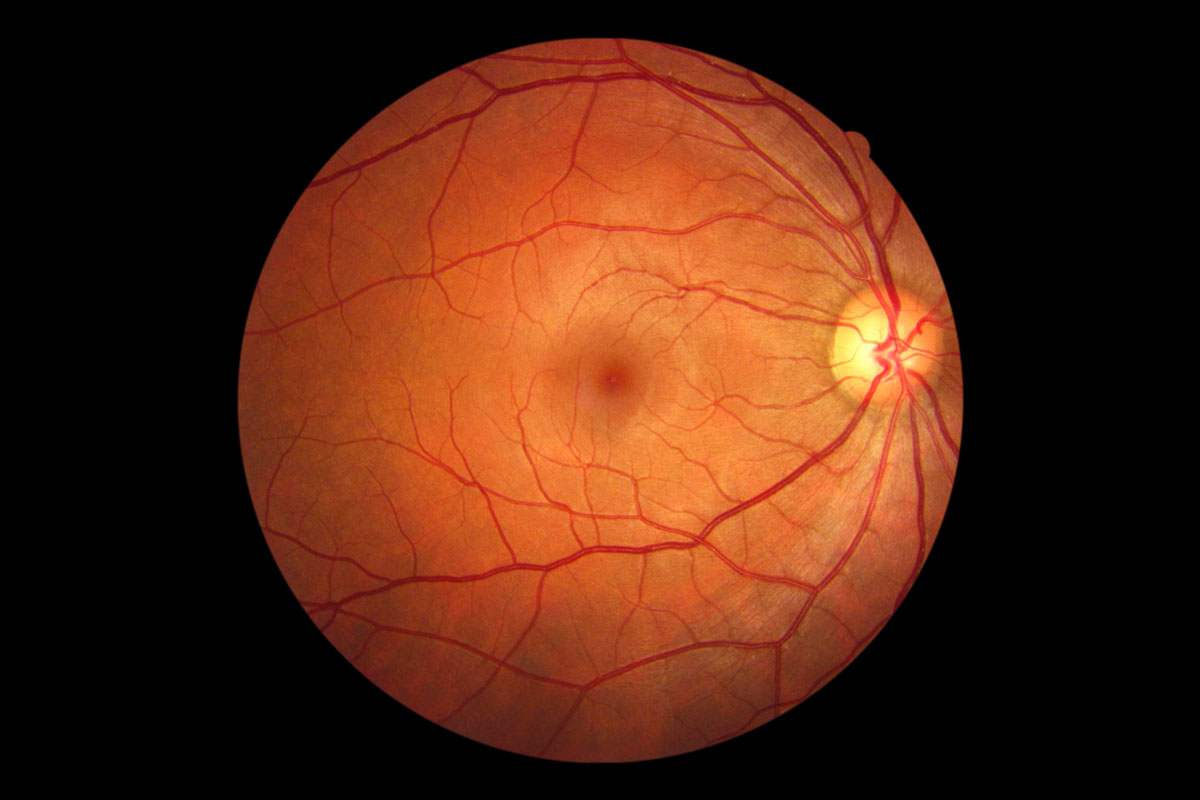 https://my.clevelandclinic.org/-/scassets/images/org/health/articles/25046-retinal-imaging