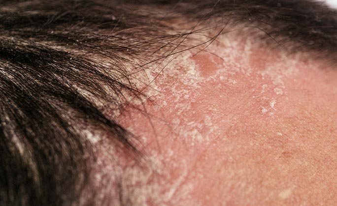 Scales on a person’s forehead are signs of psoriasis on the face.