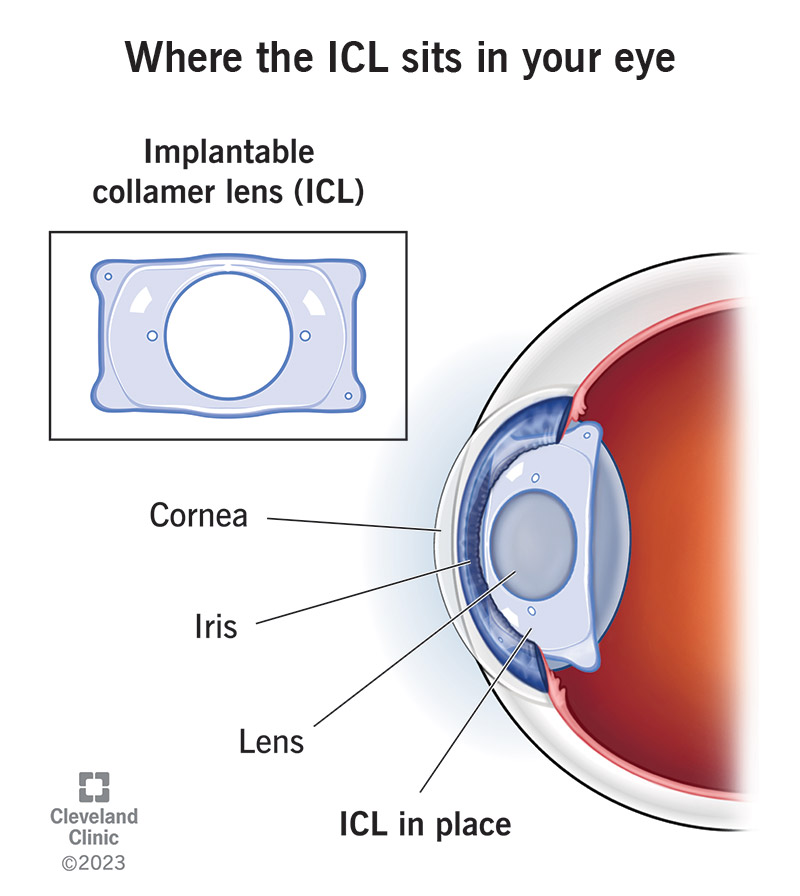 An implantable collamer lens sits between your iris and the natural lens in your eye.