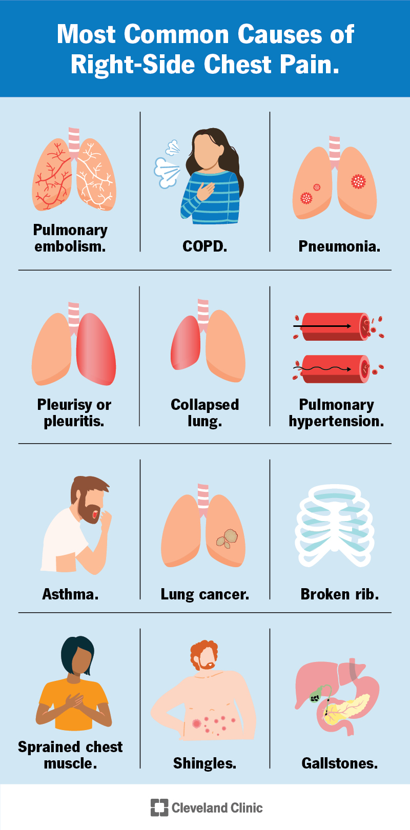 12 Causes of RightSided Chest Pain