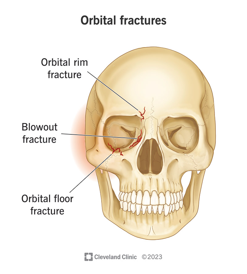 An orbital rim fracture, a blowout fracture and an orbital floor fracture.