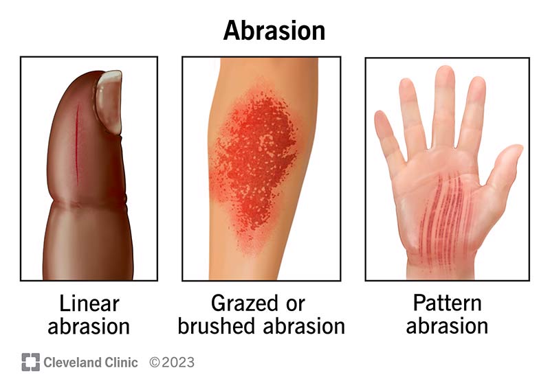 Three types of abrasions with different patterns after an injury where your skin rubs off.