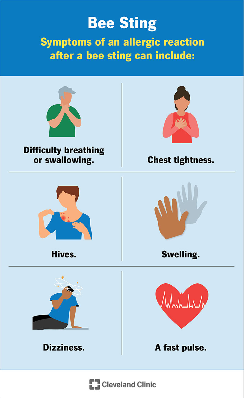 Symptoms of an allergic reaction caused by a bee sting that require medical attention.