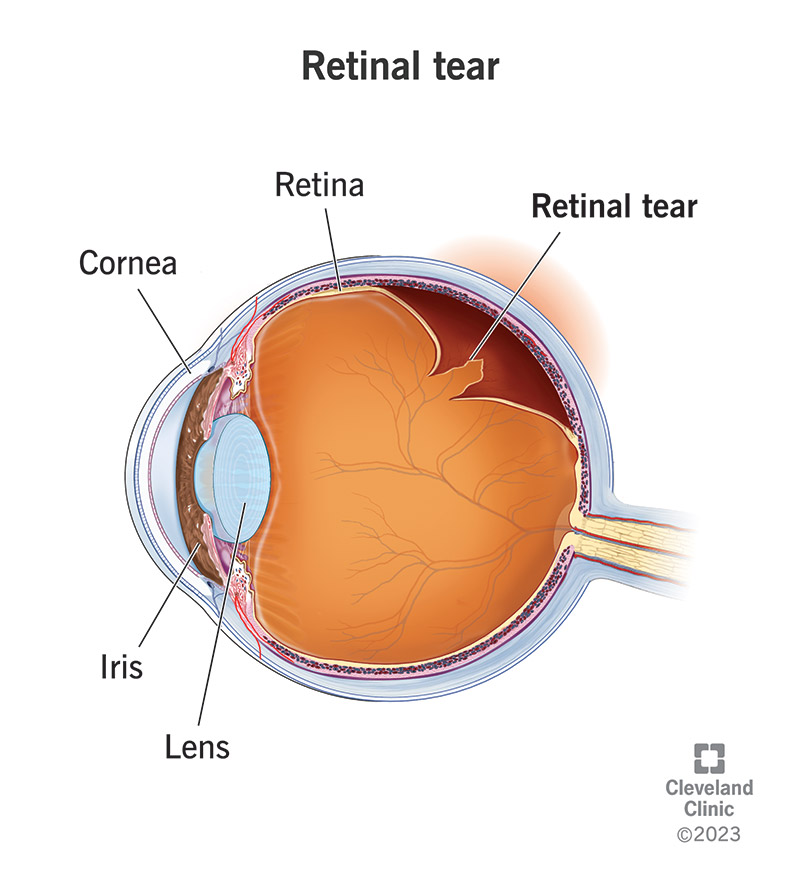 Your eye includes the iris, lens, cornea and retina, and the vitreous can pull on the retina to cause a retinal tear.