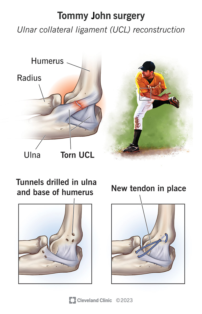Tommy John surgery repairs a tear in the ulnar collateral ligament.