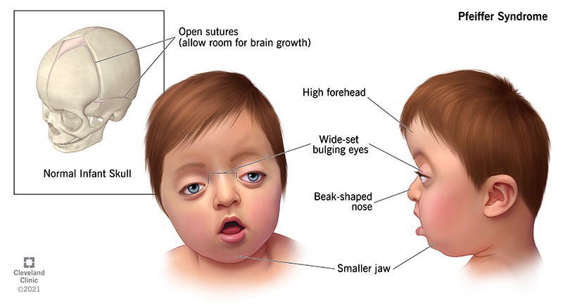 The symptoms of a baby born with Pfeiffer syndrome compared to a baby’s skull without the condition.