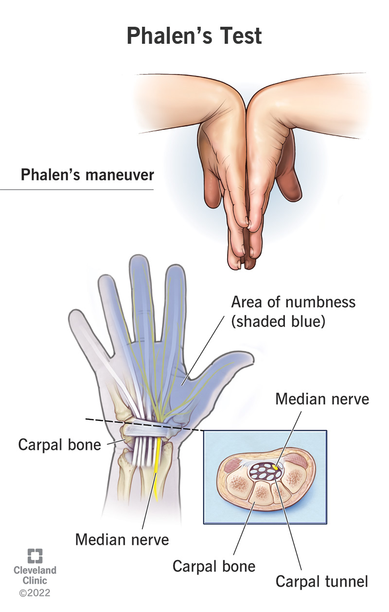 An illustration of the Phalen's maneuver and the parts of a hand and wrist affected by carpal tunnel syndrome