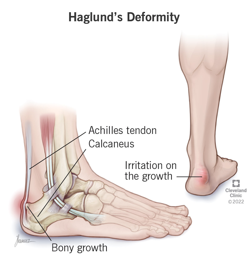 Haglund's deformity causes a bony growth on your heel bone (calcaneus)