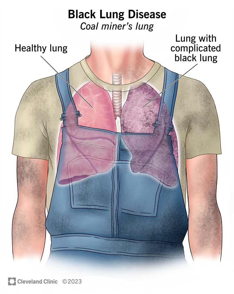 In complicated black lung disease, scarring is severe and the lung looks black. Healthy lungs are pink.